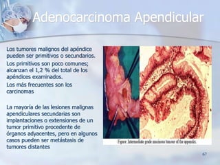 Adenocarcinoma Apendicular
Los tumores malignos del apéndice
pueden ser primitivos o secundarios.
Los primitivos son poco ...