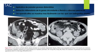 TAC  Apéndice de paredes gruesas distendidas
 Estriación inflamatoria de la grasa circundante o flemón o absceso pericecal.
 Los apendicolitos se muestras mas fácilmente con tac que con radiografías simples.
 
