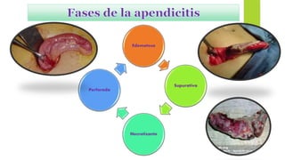 APENDICITIS AGUDA
Edematosa
Supurativa
Necrotizante
Perforada
 