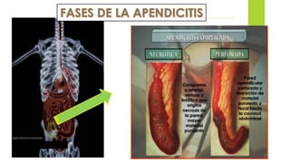 APENDICITIS
Compromis
o arterial,
venoso y
linfático que
origina
necrosis de
la pared,
mayor
material
purulento
Pared
apendicular
perforada y
liberación de
material
purulento y
fecal hacia
la cavidad
abdominal
 