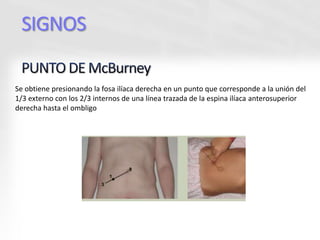 SIGNOS
Se obtiene presionando la fosa ilíaca derecha en un punto que corresponde a la unión del
1/3 externo con los 2/3 internos de una línea trazada de la espina ilíaca anterosuperior
derecha hasta el ombligo
 