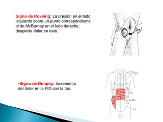 Apendicitis | PPT