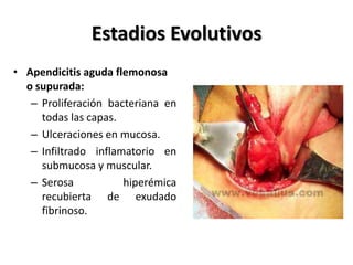 Estadios Evolutivos
• Apendicitis aguda flemonosa
  o supurada:
   – Proliferación bacteriana en
     todas las capas.
   – Ulceraciones en mucosa.
   – Infiltrado inflamatorio en
     submucosa y muscular.
   – Serosa           hiperémica
     recubierta de exudado
     fibrinoso.
 