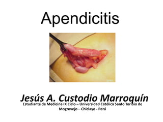 Apendicitis



Jesús A. Custodio Marroquín
Estudiante de Medicina IX Ciclo – Universidad Católica Santo Toribio de
                    Mogrovejo – Chiclayo - Perú
 