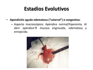 Estadios Evolutivos
          • Apendicitis aguda necrótica
            o gangrenosa:
             – Exudado         perit...