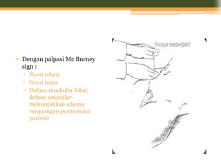 • Dengan palpasi Mc Burney
sign :
▫ Nyeri tekan
▫ Nyeri lepas
▫ Defans muskular lokal,
defans muscular
menunjukkan adanya
rangsangan peritoneum
parietal
 