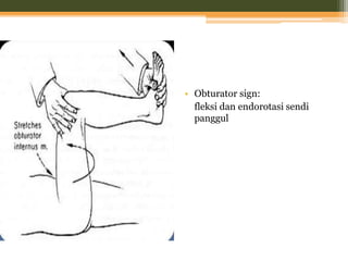 • Obturator sign:
fleksi dan endorotasi sendi
panggul
 