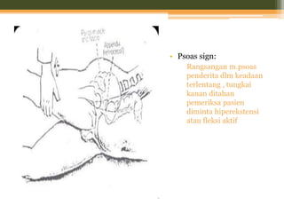 • Psoas sign:
Rangsangan m.psoas
penderita dlm keadaan
terlentang , tungkai
kanan ditahan
pemeriksa pasien
diminta hiperekstensi
atau fleksi aktif
 