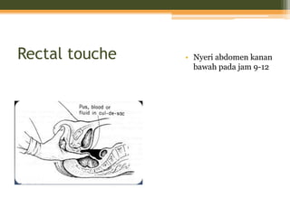 Rectal touche • Nyeri abdomen kanan
bawah pada jam 9-12
 