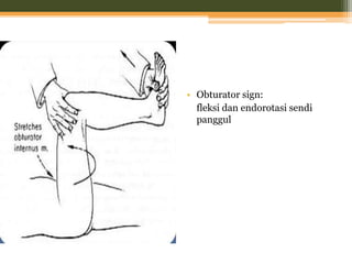 • Obturator sign:
fleksi dan endorotasi sendi
panggul
 