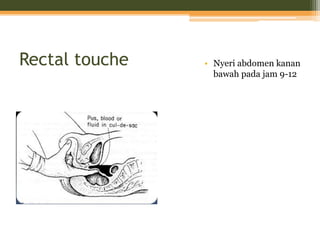 Rectal touche • Nyeri abdomen kanan
bawah pada jam 9-12
 