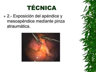 TÉCNICA
 2.- Exposición del apéndice y
mesoapéndice mediante pinza
atraumática.
 