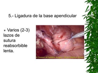 5.- Ligadura de la base apendicular
 Varios (2-3)
lazos de
sutura
reabsorbible
lenta.
 