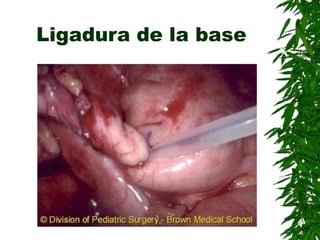 Ligadura de la base
 