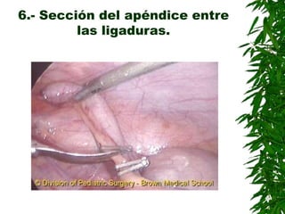 6.- Sección del apéndice entre
las ligaduras.
 