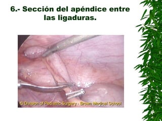 6.- Sección del apéndice entre
las ligaduras.
 