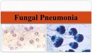 Fungal Pneumonia
1
 