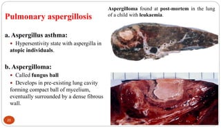 20
Pulmonary aspergillosis
a. Aspergillus asthma:
 Hypersentivity state with aspergilla in
atopic individuals.
b. Aspergilloma:
 Called fungus ball
 Develops in pre-existing lung cavity
forming compact ball of mycelium,
eventually surrounded by a dense fibrous
wall.
Aspergilloma found at post-mortem in the lung
of a child with leukaemia.
 