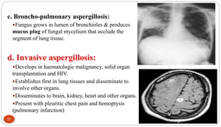 21
c. Broncho-pulmonary aspergillosis:
Fungus grows in lumen of bronchioles & produces
mucus plug of fungal mycelium that occlude the
segment of lung tissue.
d. Invasive aspergillosis:
Develops in haematologic malignancy, solid organ
transplantation and HIV.
Establishes first in lung tissues and disseminate to
involve other organs.
Disseminates to brain, kidney, heart and other organs.
Present with pleuritic chest pain and hemoptysis
(pulmonary infarction)
 