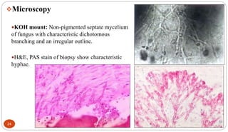 24
Microscopy
KOH mount: Non-pigmented septate mycelium
of fungus with characteristic dichotomous
branching and an irregular outline.
H&E, PAS stain of biopsy show characteristic
hyphae.
 
