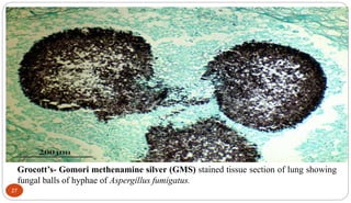 Grocott’s- Gomori methenamine silver (GMS) stained tissue section of lung showing
fungal balls of hyphae of Aspergillus fumigatus.
27
 