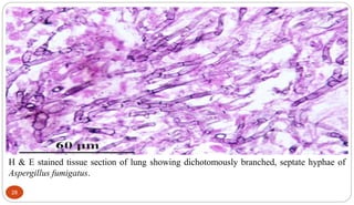 H & E stained tissue section of lung showing dichotomously branched, septate hyphae of
Aspergillus fumigatus.
28
 