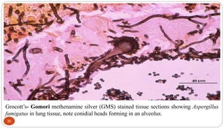 Grocott’s- Gomori methenamine silver (GMS) stained tissue sections showing Aspergillus
fumigatus in lung tissue, note conidial heads forming in an alveolus.
30
 