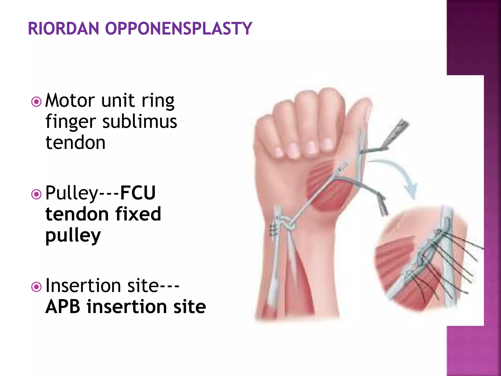 Ape thumb deformity to publish | PPTX