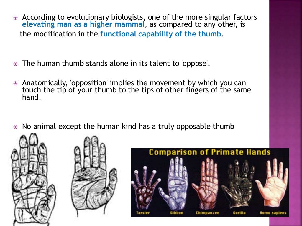Ape thumb deformity to publish