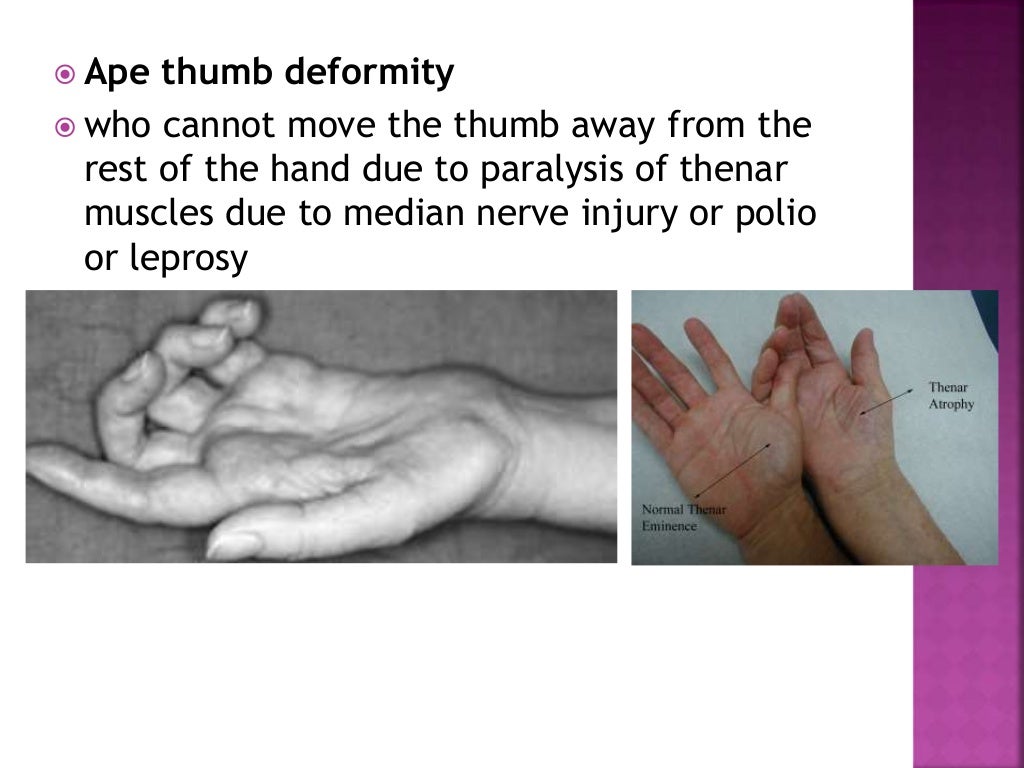 Ape thumb deformity to publish