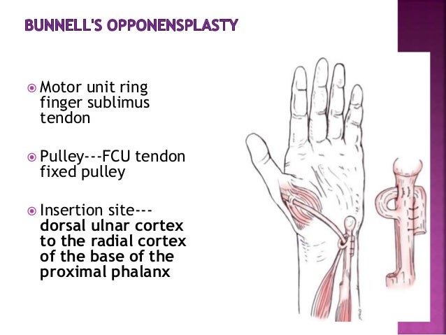 Ape Thumb Deformity To Publish