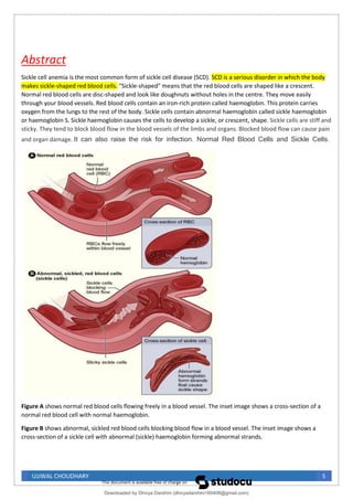 UJJWAL CHOUDHARY 5
Abstract
Sickle cell anemia is the most common form of sickle cell disease (SCD). SCD is a serious disorder in which the body
makes sickle-shaped red blood cells. “Sickle-shaped” means that the red blood cells are shaped like a crescent.
Normal red blood cells are disc-shaped and look like doughnuts without holes in the centre. They move easily
through your blood vessels. Red blood cells contain an iron-rich protein called haemoglobin. This protein carries
oxygen from the lungs to the rest of the body. Sickle cells contain abnormal haemoglobin called sickle haemoglobin
or haemoglobin S. Sickle haemoglobin causes the cells to develop a sickle, or crescent, shape. Sickle cells are stiff and
sticky. They tend to block blood flow in the blood vessels of the limbs and organs. Blocked blood flow can cause pain
and organ damage. It can also raise the risk for infection. Normal Red Blood Cells and Sickle Cells.
Figure A shows normal red blood cells flowing freely in a blood vessel. The inset image shows a cross-section of a
normal red blood cell with normal haemoglobin.
Figure B shows abnormal, sickled red blood cells blocking blood flow in a blood vessel. The inset image shows a
cross-section of a sickle cell with abnormal (sickle) haemoglobin forming abnormal strands.
Downloaded by Dhivya Darshini (dhivyadarshini160408@gmail.com)
lOMoARcPSD|41270447
 