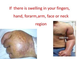 If there is swelling in your fingers,
hand, forarm,arm, face or neck
region
 