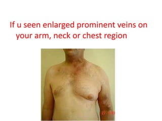 If u seen enlarged prominent veins on
your arm, neck or chest region
 