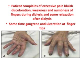 • Patient complains of excessive pain bluish
discoloration, weakness and numbness of
fingers during dialysis and some relaxation
after dialysis
• Some time gangrene and ulceration at finger
tips
 