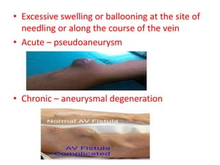 • Excessive swelling or ballooning at the site of
needling or along the course of the vein
• Acute – pseudoaneurysm
• Chronic – aneurysmal degeneration
 