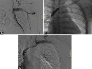 APEX dialysis cme.pptx