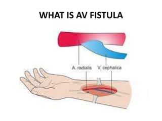 WHAT IS AV FISTULA
 