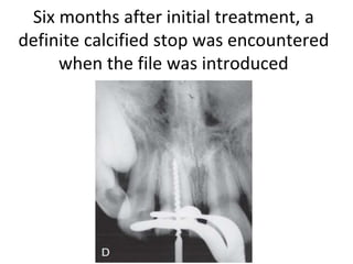 Six months after initial treatment, a
definite calcified stop was encountered
when the file was introduced
 