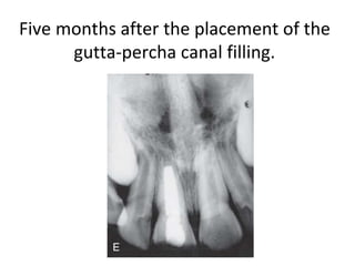 Five months after the placement of the
gutta-percha canal filling.
 