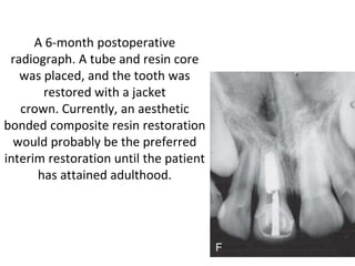 A 6-month postoperative
radiograph. A tube and resin core
was placed, and the tooth was
restored with a jacket
crown. Currently, an aesthetic
bonded composite resin restoration
would probably be the preferred
interim restoration until the patient
has attained adulthood.
 
