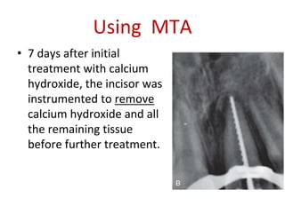 Using MTA
• 7 days after initial
treatment with calcium
hydroxide, the incisor was
instrumented to remove
calcium hydroxide and all
the remaining tissue
before further treatment.
 