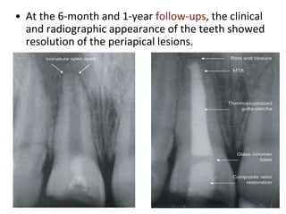 • At the 6-month and 1-year follow-ups, the clinical
and radiographic appearance of the teeth showed
resolution of the periapical lesions.
 
