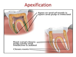 Apexification
 
