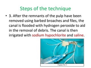 Steps of the technique
• 3. After the remnants of the pulp have been
removed using barbed broaches and files, the
canal is flooded with hydrogen peroxide to aid
in the removal of debris. The canal is then
irrigated with sodium hypochlorite and saline.
 