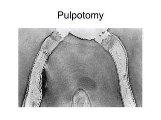 Pulpotomy
 
