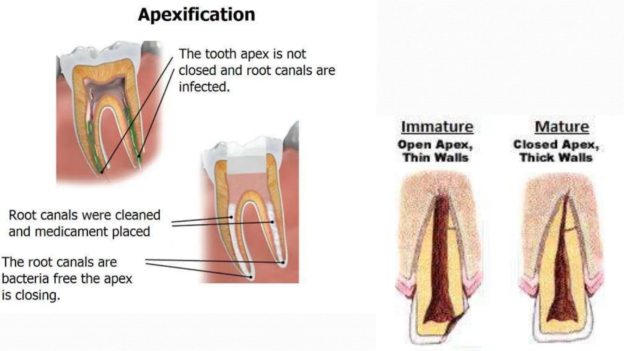 Apexification in endodontics PowerPoint presentation | PPTX