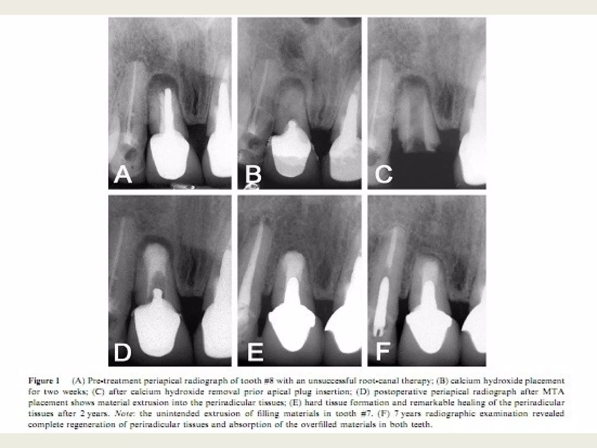 Apexification  apexogenesis  MTA  mineral trioxide aggregate powerpoint presentation