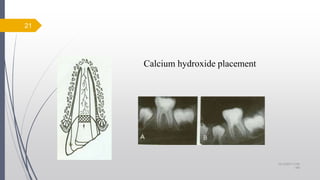 Calcium hydroxide placement
21
10/12/2017 4:59
AM
 