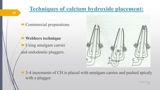 Techniques of calcium hydroxide placement:
Commercial preparations
Webbers technique
Using amalgam carrier
and endodontic pluggers.
3-4 increments of CH is placed with amalgam carries and pushed apicaly
with a plugger.
46
10/12/2017 4:59
AM
 
